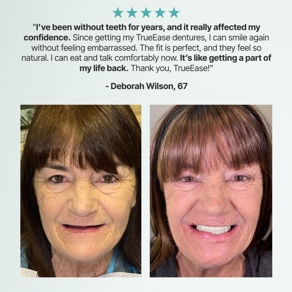 TrueEase™ Custom-Fit Full Functional Dentures